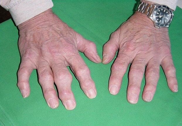 Артроза на пръстите