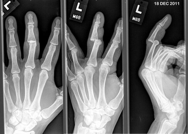 Рентгенова снимка на изкълчените пръсти