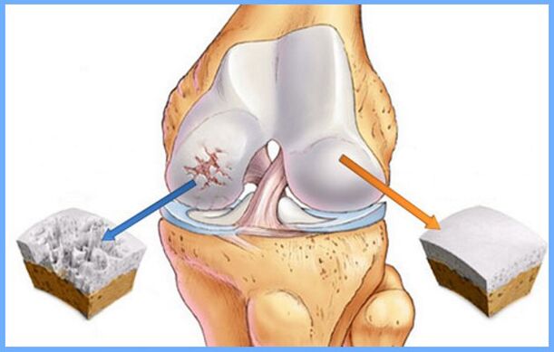 Нормална колянна става и засегната от артроза