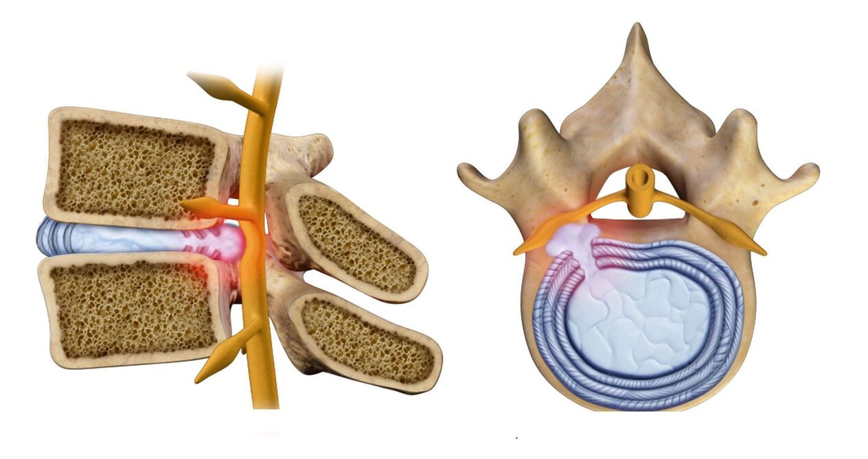 гръбначна херния при остеохондроза на гръдния кош