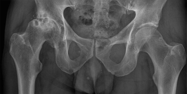 Деформираща артроза на тазобедрената става на рентгенова снимка
