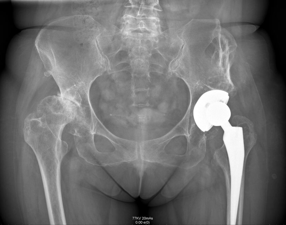 Рентгенова снимка на тазобедрената става след ендопротезиране