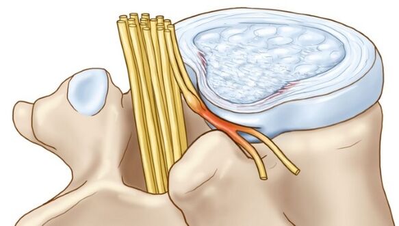 Лумбалната остеохондроза може да доведе до усложнения под формата на междупрешленна херния
